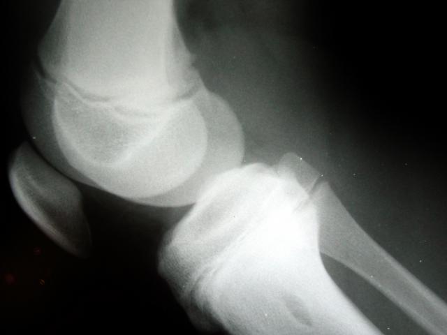 Knee X-ray